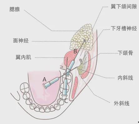 下颌阻滞麻醉视频教学,下颌阻滞麻醉操作步骤与技巧解析